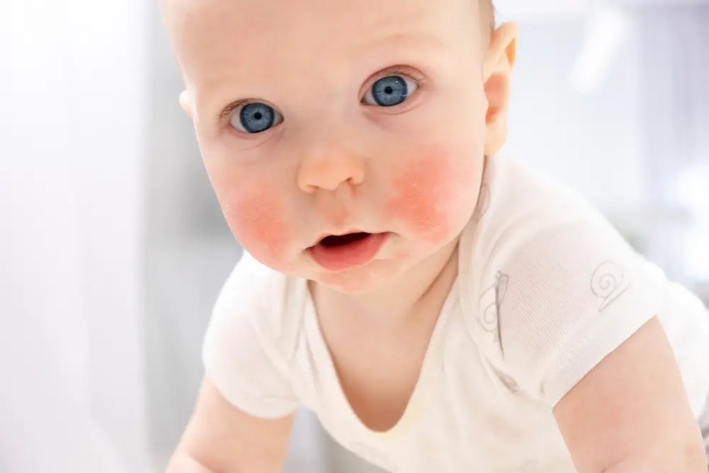 Eczema and atopic dermatitis in children or babies - May App Health
