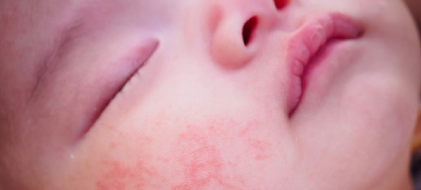 Eczema-bébé