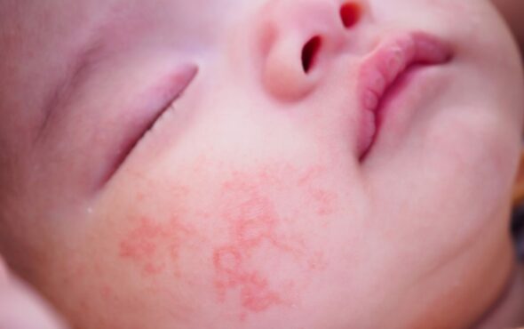 Eczéma et dermatite atopique chez l'enfant ou le bébé - May App Santé