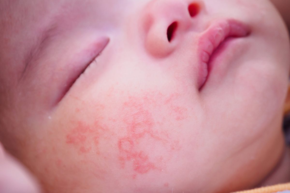 Eczéma et dermatite atopique chez l'enfant/bébé - May app