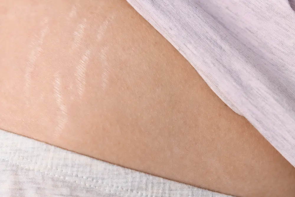 Les vergetures de grossesse : comment les éviter ? - May App Santé