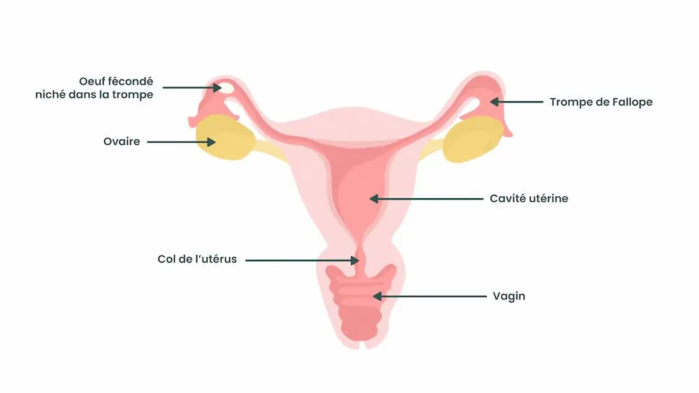 Grossesse extra-utérine : comment la détecter ? may app santé