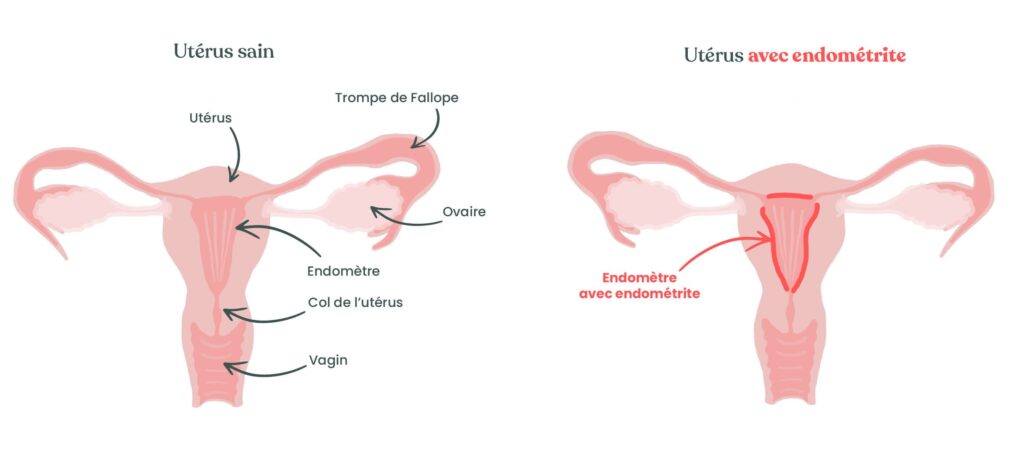 endométrite