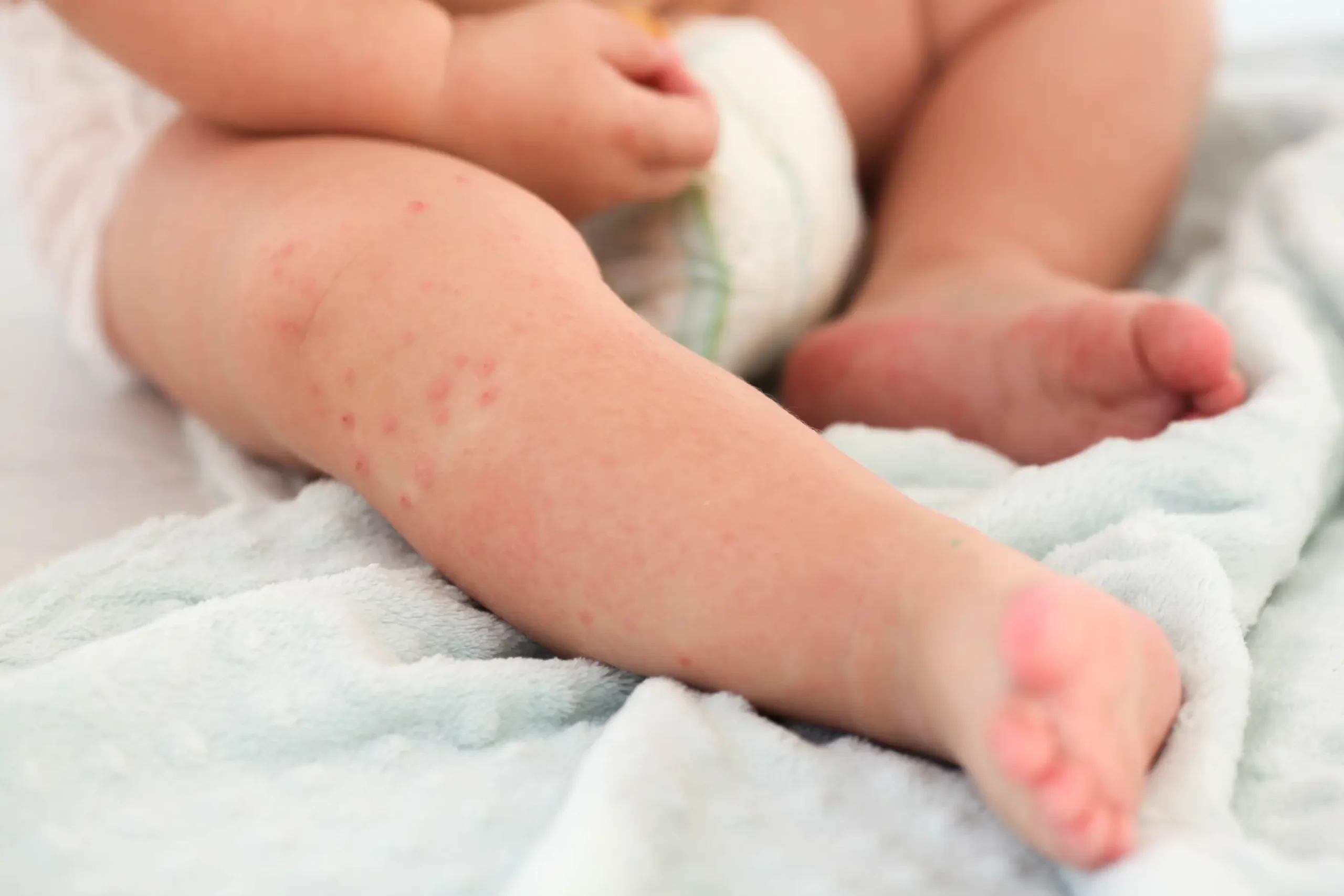 Varicelle chez le nourrisson : que faire ? may app santé