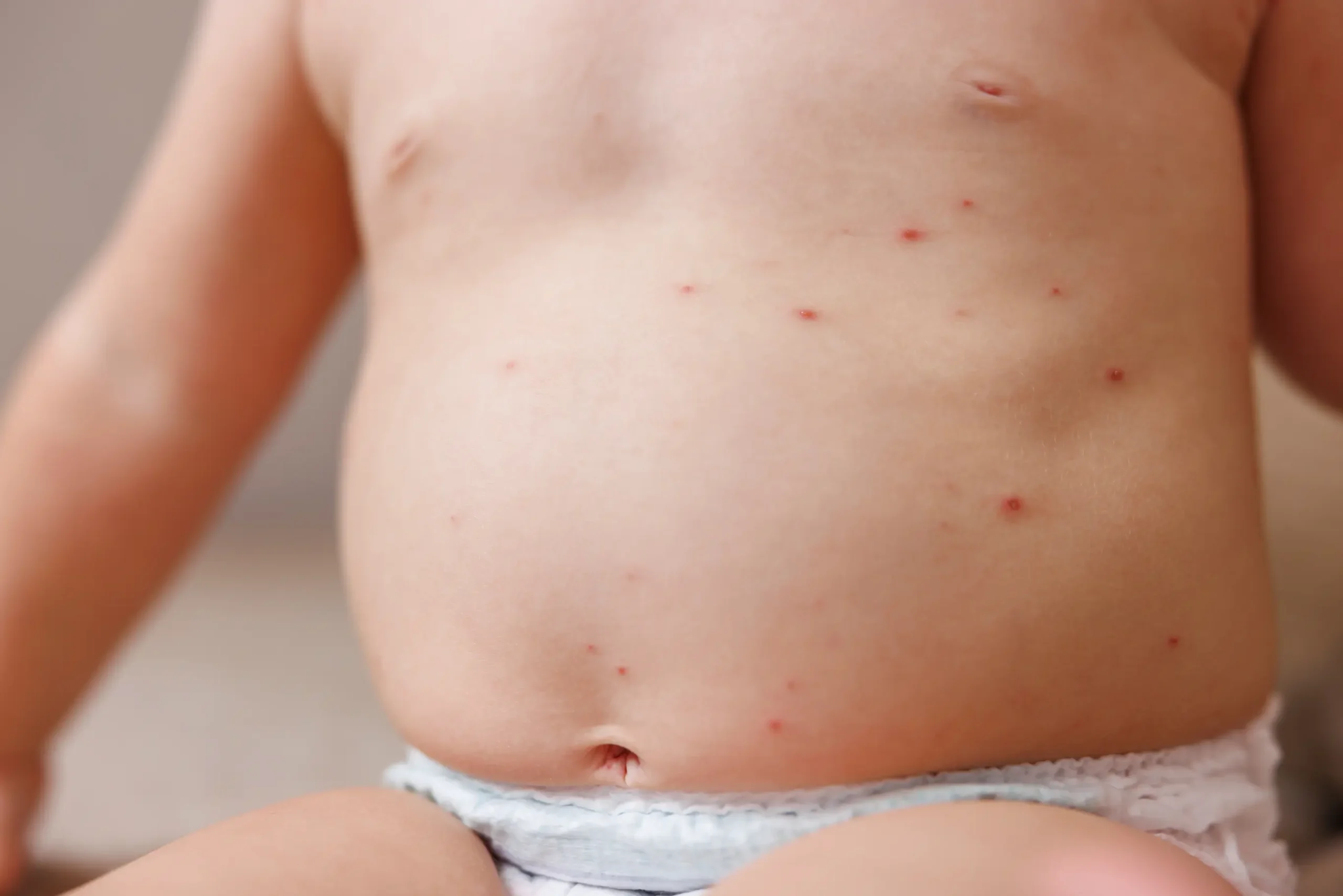 Varicelle chez le nourrisson : que faire ? may app santé