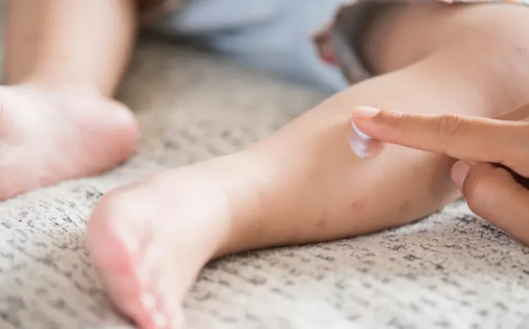 Varicelle chez le nourrisson : que faire ? may app santé