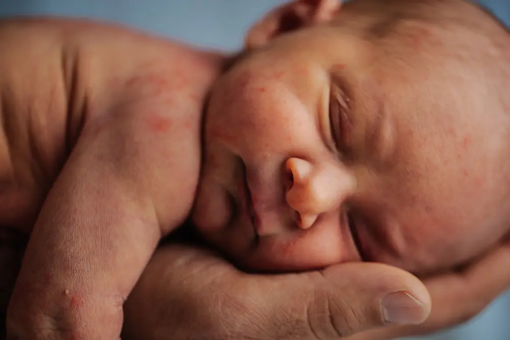 L'érythème toxique du nouveau-né, un mal bénin 4 L'érythème toxique du nouveau-né - May App Santé