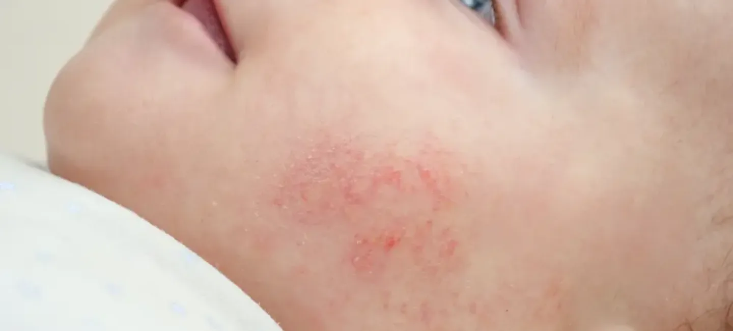 L'érythème toxique du nouveau-né - May App Santé