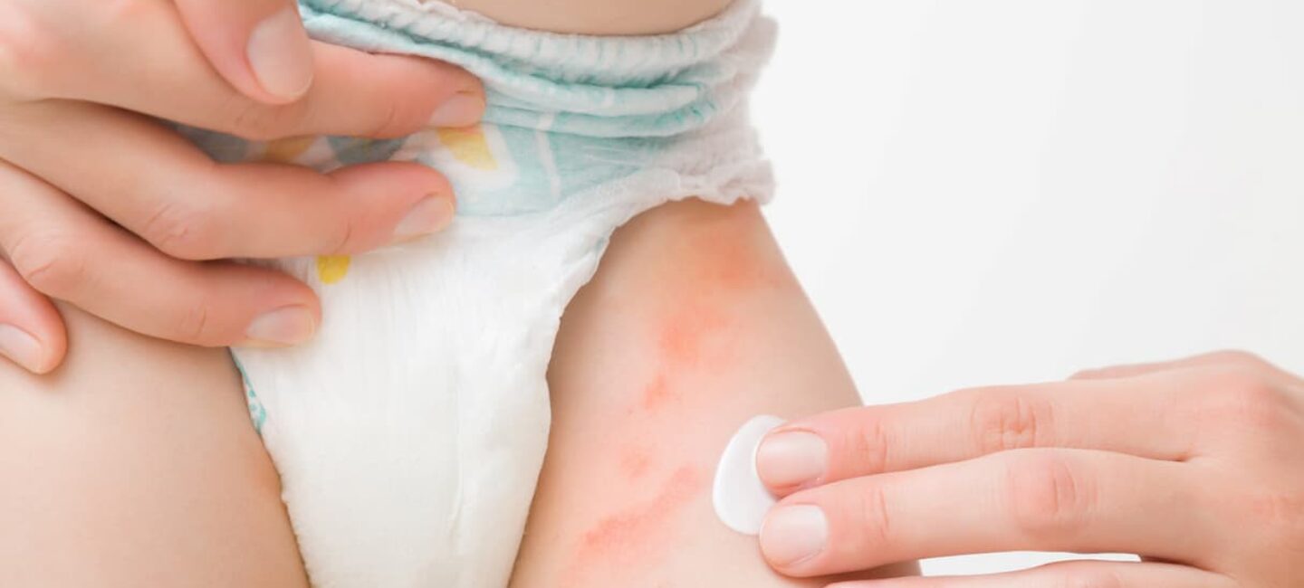 Fesses rouges et mycose du siège chez bébé : que faire ?