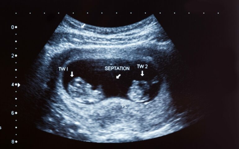 taux bêta-hCG grossesse gémellaire