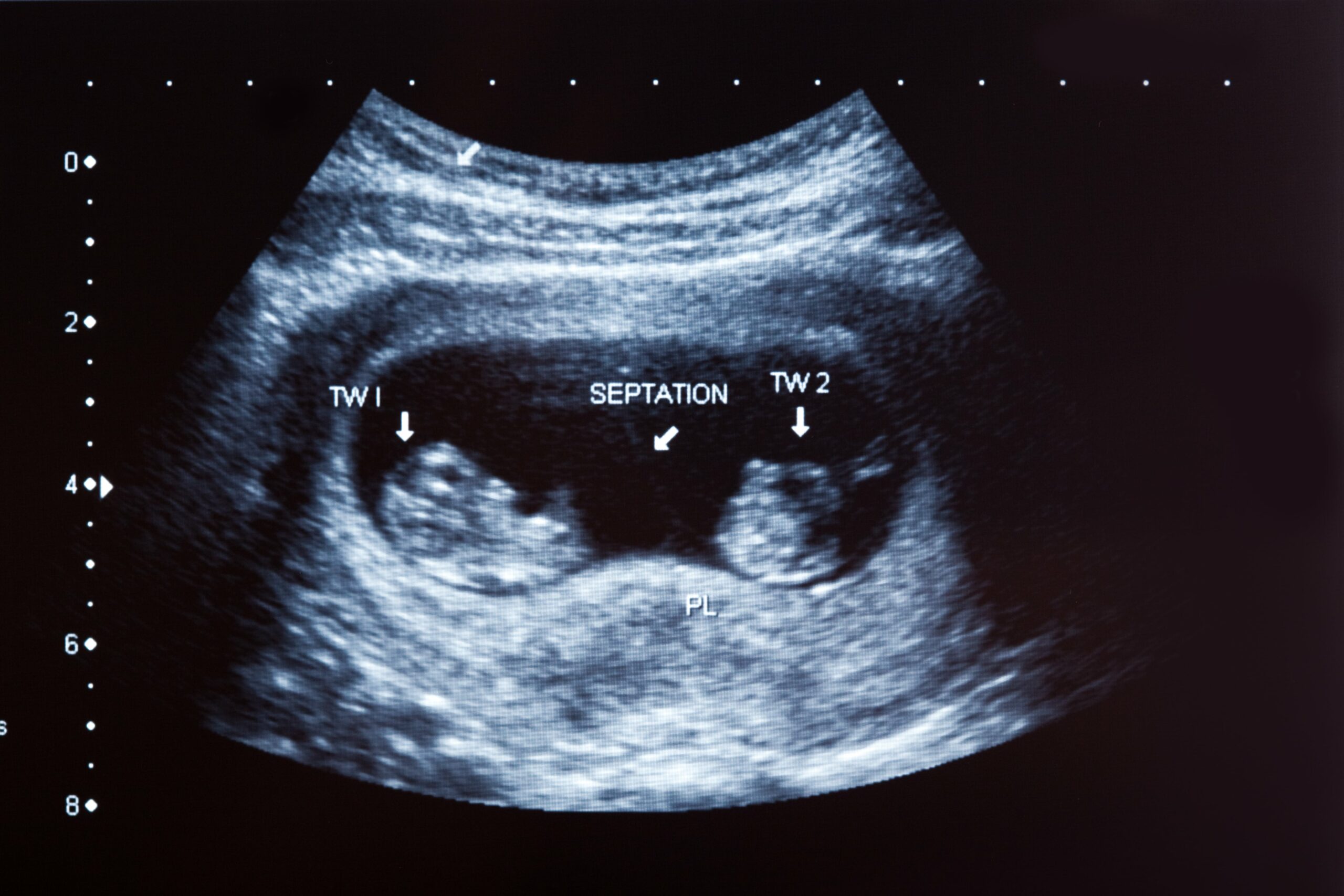 Échographies obstétricales : leur rôle pendant la grossesse