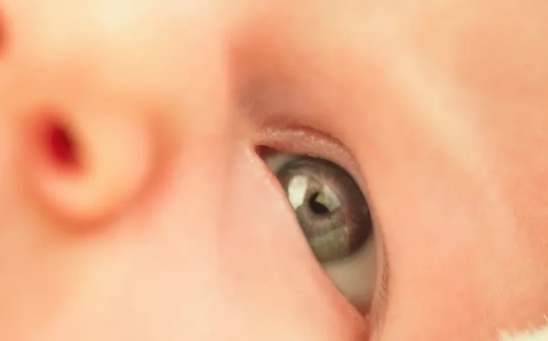 Yeux vairons chez l'enfant : tout savoir may app santé