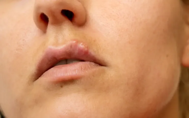 Bouton de fièvre enceinte : comprendre et agir pendant la grossesse - May App Santé