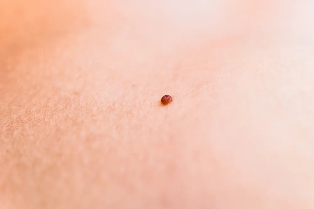 Grain de beauté chez mon bébé de 2 ans : faut-il s’inquiéter ? 1 Grain de beauté chez mon bébé de 2 ans : faut-il s’inquiéter ? - May App Santé