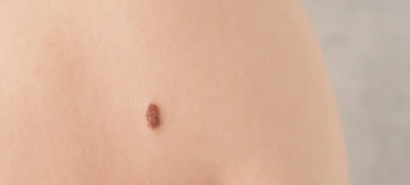 Grain de beauté chez mon bébé de 2 ans : faut-il s’inquiéter ? - May App Santé